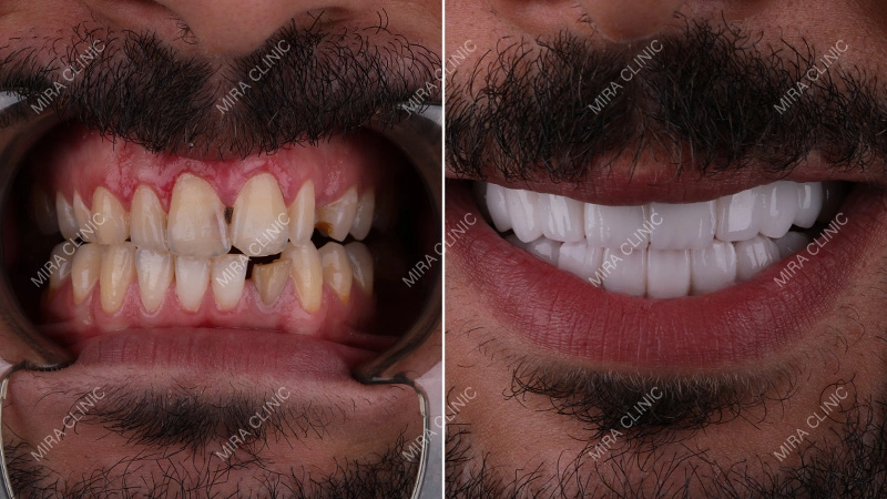 Before and After missing teeth Dental Treatment